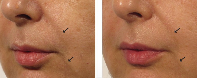 Dubai oxygeneo facial